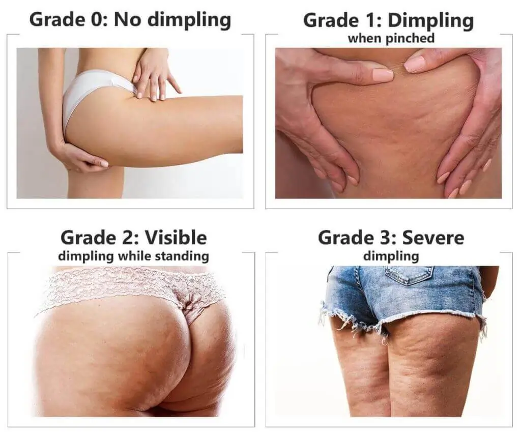 Representation of the stages of cellulite development Ampthill